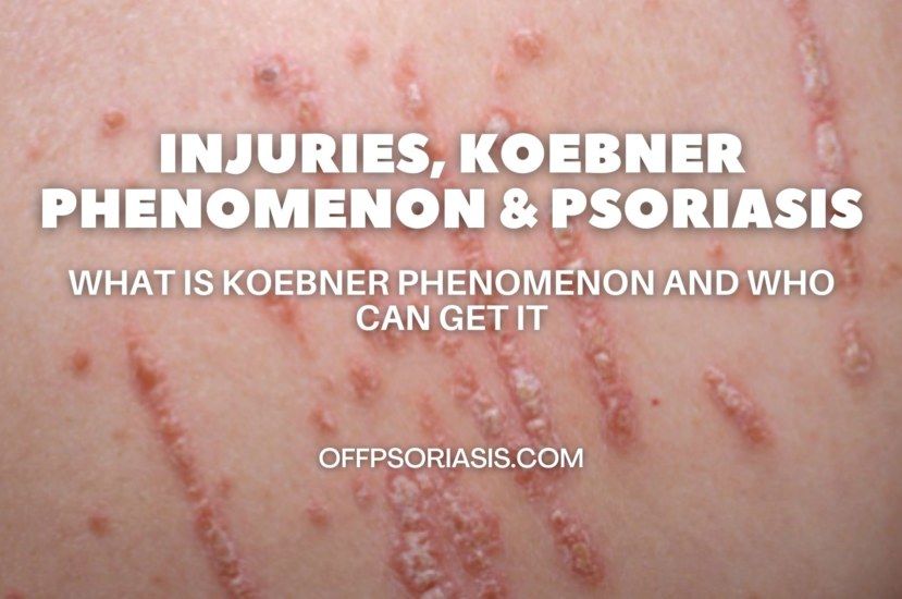 Injuries Koebner Phenomenon and Psoriasis OffPsoriasis