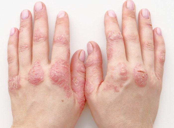 Psoriasis Types Offpsoriasis