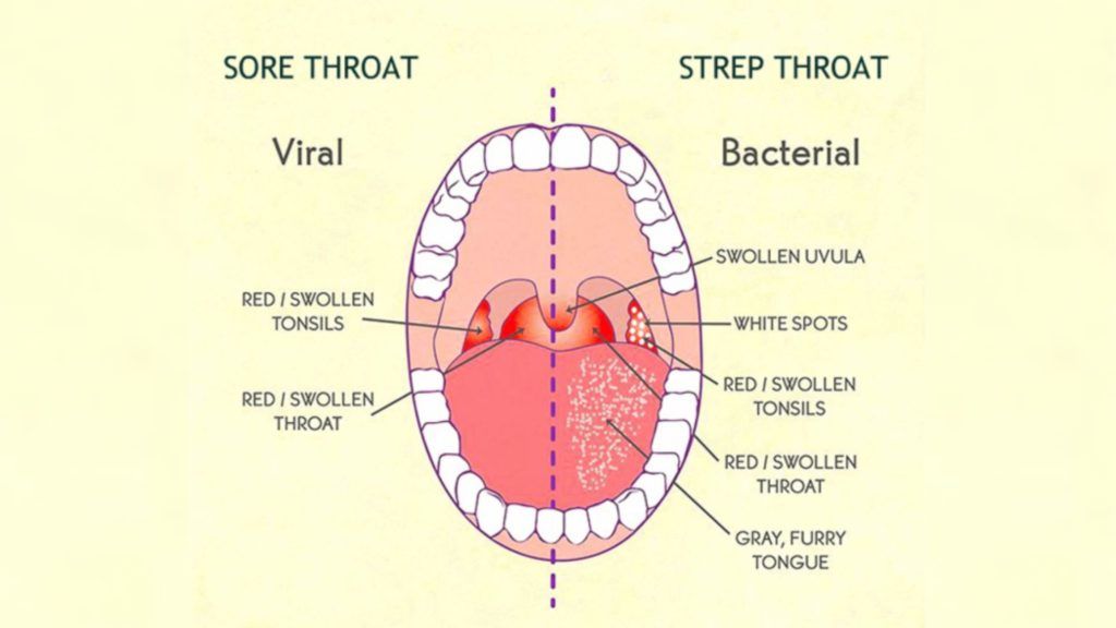 Throat Infections and Psoriasis Connection – OffPsoriasis